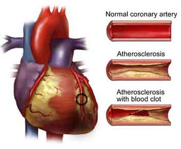 Heart Disease: Education as a Means of Combating The Silent Killer 