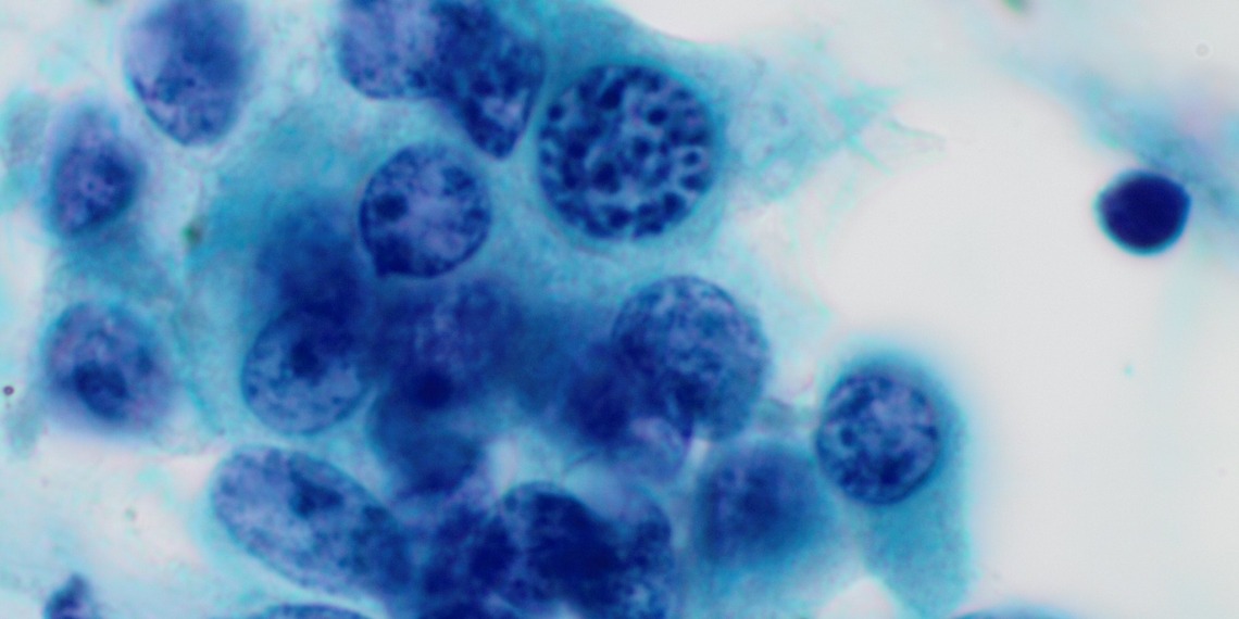 early-onset cancer