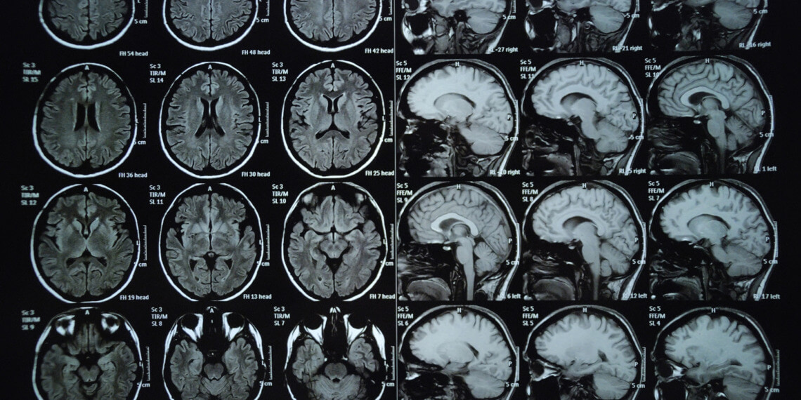 climate change brain