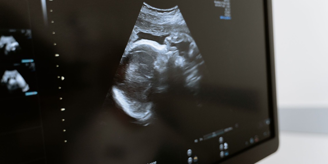 A black and white ultrasound photo on a monitor.