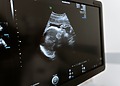 A black and white ultrasound photo on a monitor.